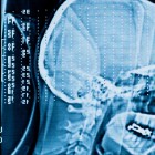brain injury